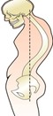 kyphosis