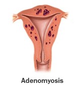 Adenomyoma picture