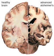 Alzheimer's brain