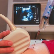 Amniocentesis carried out in early second trimester