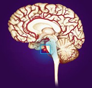 Aneurysm causes hemorrhagic