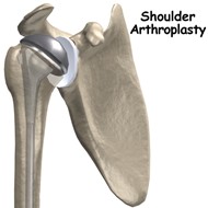 shoulder replacement surgery