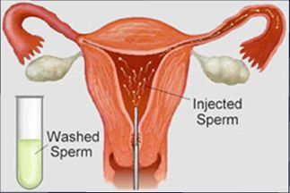 artificial insemination