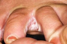 itchy feet symptoms
