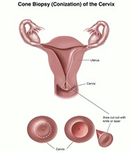 Cone Biopsy