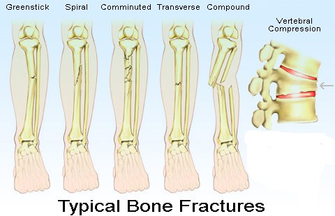 types of bone fractures