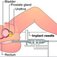 Brachytherapy Radiation Therapy
