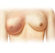 Breast Cancer Stages