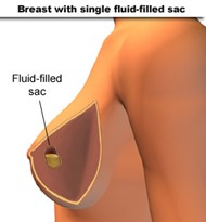 breast cyst picture
