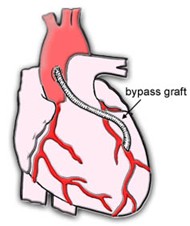 Bypass Surgery