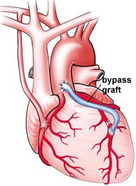 Diagram of CABG Surgery