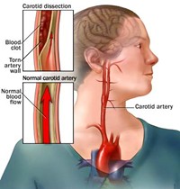 Ischemic Stroke in Women