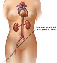 Cath Diagram