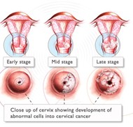 Stages of Cervix Cancer