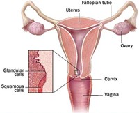 Cancer of Cervix