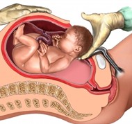 cesarean section delivery