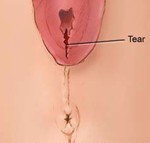 vaginal laceration