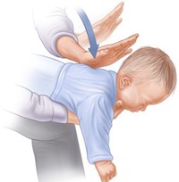 baby choking treatment