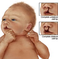 Cleft Lip Picture