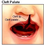 Cleft Palate Picture