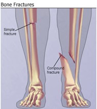 closed fracture