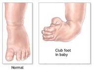 Club Feet