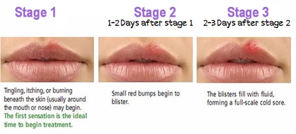 stages of a cold sore