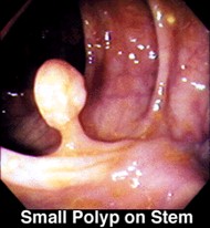 Adenomatous