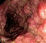 Inflammatory Colon Polyps