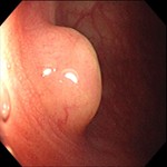 Hyperplastic colon polyp