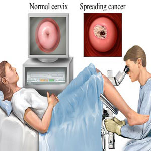 colposcopy exam