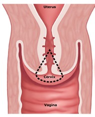 Cone Biopsy