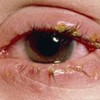 conjuctivitis picture
