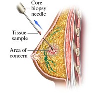 Breast Biopsy Picture