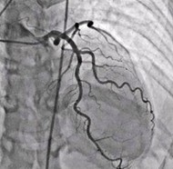 Angiogram