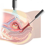 chorionic villus sampling
