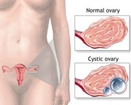 Medical Diagram of Cystic Ovary