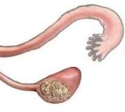 Dermoid Ovary Cysts