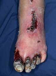 Foot complications