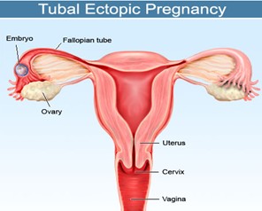 tubal pregnancy picture