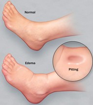 pitting edema