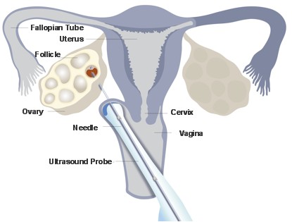follicle aspiration