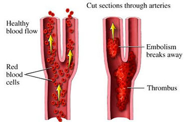 How an embolism forms