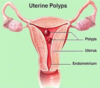 Picture of Endometrial Polyp