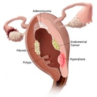 Endometrial Hyperplasia diagram