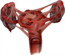 picture of endometrial implants severe stage