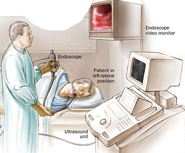 endoscopic ultrasound