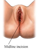 midline episiotomy incision