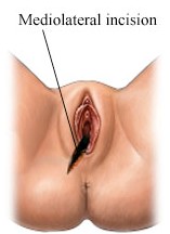 mediolateral incision
