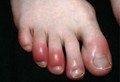 picture of raynaud's phenomenon of the foot